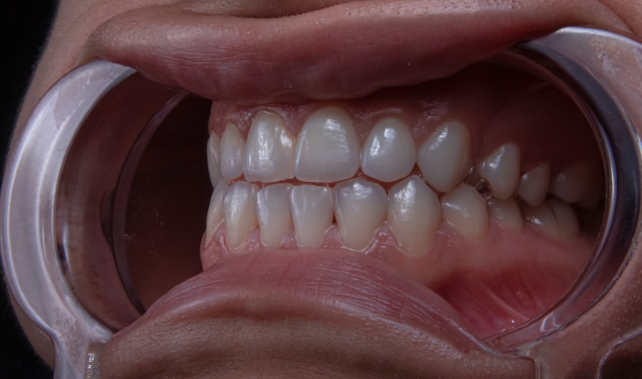 dental calculus