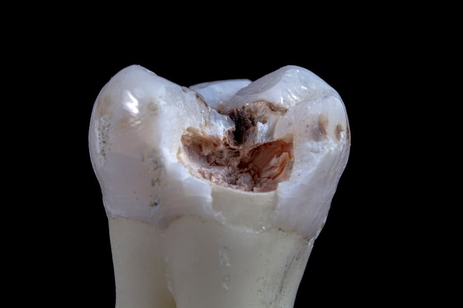 Photo extraction of molar