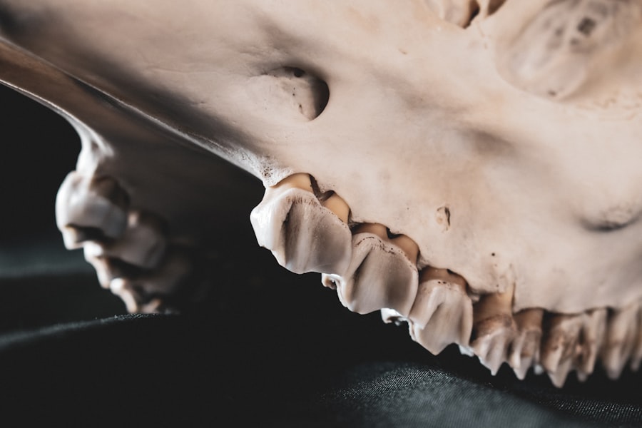 Photo dental calculus
