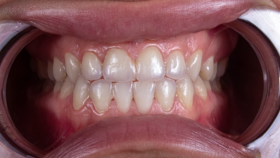 inflammation of the gums