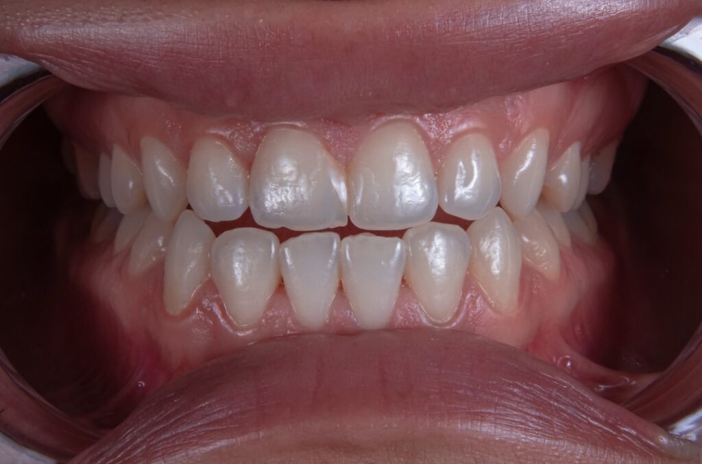 Photo inflammation of the gums