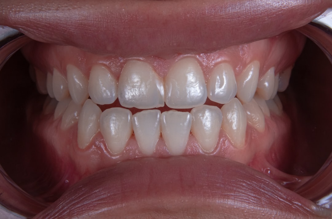 Photo inflammation of the gums