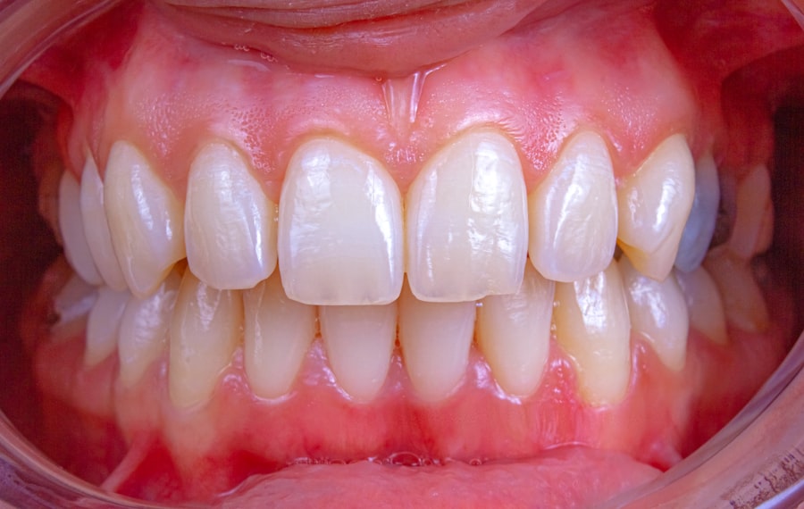 Photo inflammation of the gums