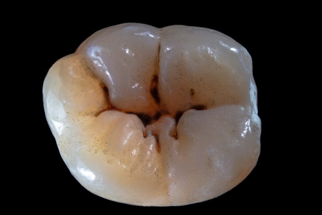 Photo gingivitis